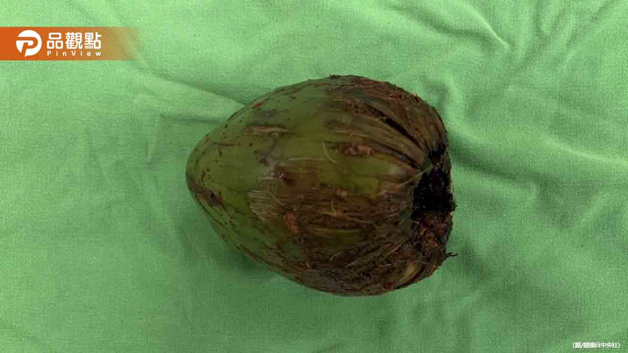 高雄奇案：男子肛門塞椰子，緊急手術取出登上國際期刊