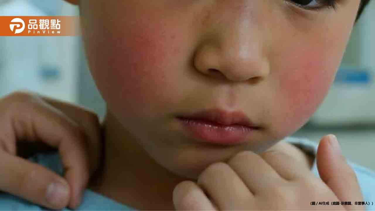 日本爆發蘋果病！5歲童遊日返台「臉頰紅如巴掌印」