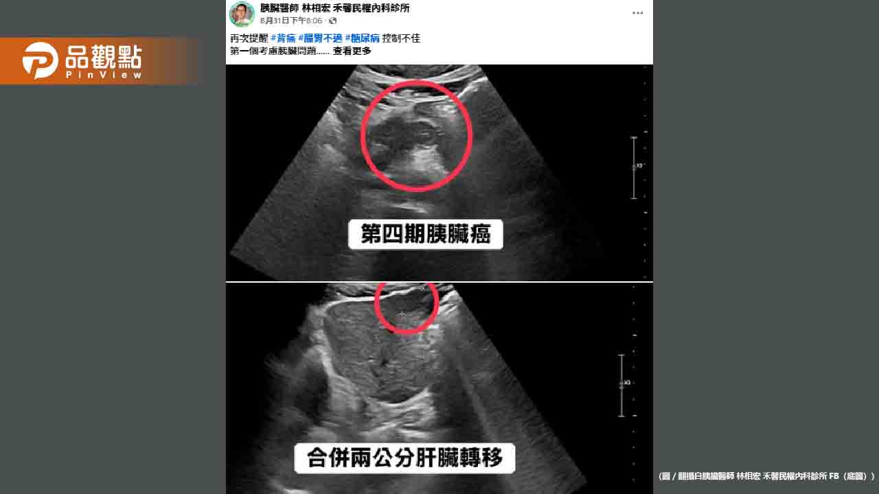 血糖失控竟是癌王警訊!50歲男確診胰臟癌四期已轉移肝臟